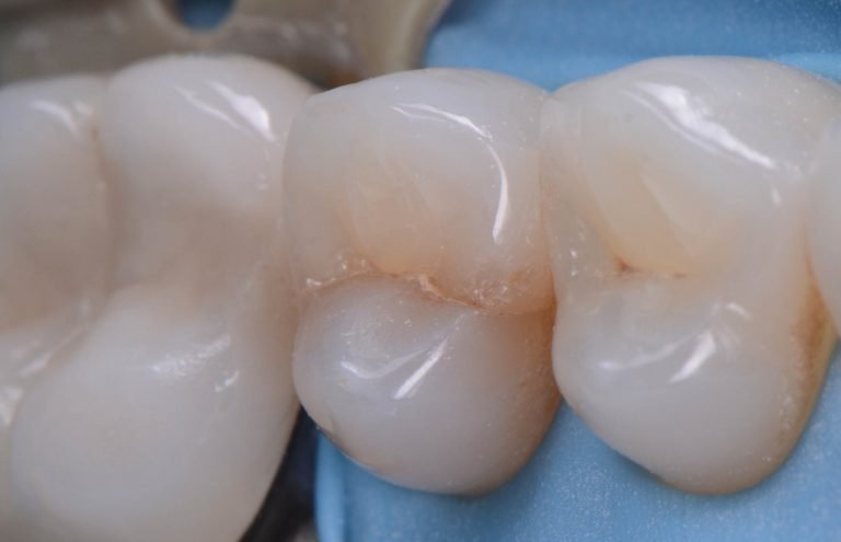 cracked-teeth-s1