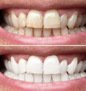 Close-up Of A Smiling Man Teeth Before And After Whitening